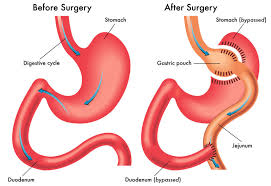 Is Gastric Bypass Right for You? Eligibility & Benefits Explained